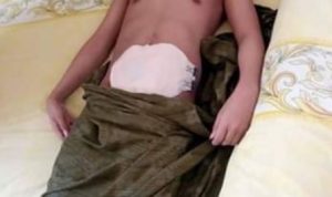 Tak ada biaya berobat, "TOMI" Warga Desa Lambai Terbaring selama setahun karena TBC Usus